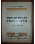 Tuberuloza pulmonara- Gh. Tudoranu